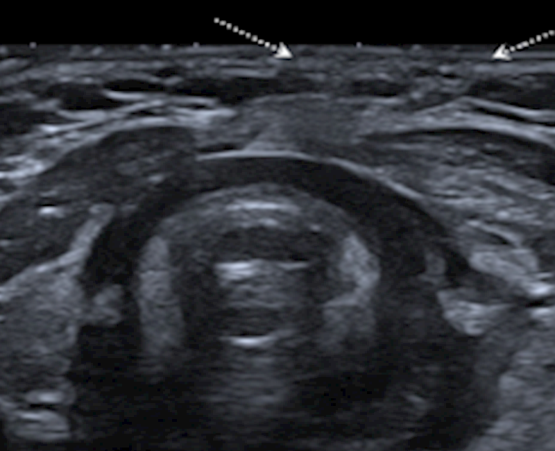 Ultrasound diagnosis of traumatic vocal cord injury